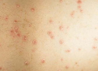 etapa inicial de la psoriasis