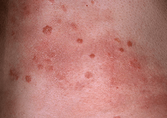 etapa progresiva de la psoriasis