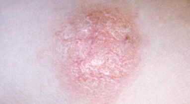Cómo reconocer la psoriasis en una etapa temprana