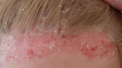 Etapas de desarrollo y síntomas de la psoriasis.