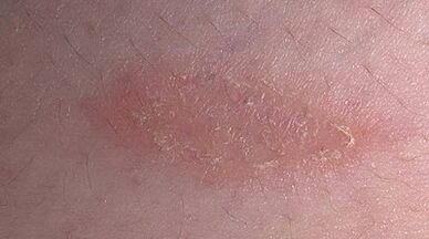 cómo y con qué tratar la psoriasis