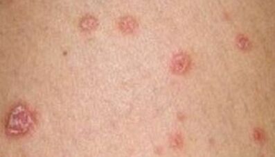 foto de psoriasis en la etapa inicial