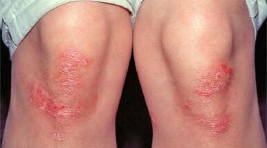 principales manifestaciones de la psoriasis