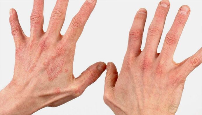 métodos para tratar la psoriasis con remedios caseros