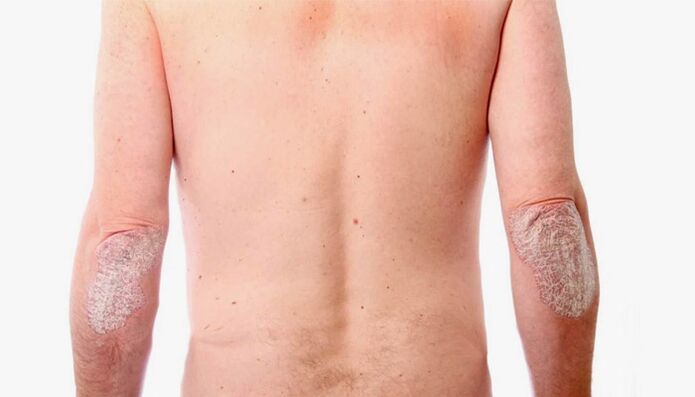 remedios caseros para el tratamiento de la psoriasis