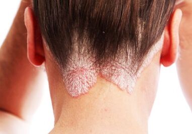 Psoriasis en la cabeza