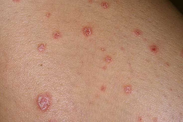 Las causas de la psoriasis