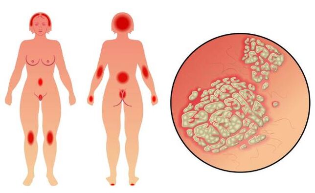 Síntomas de la psoriasis