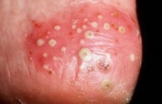 La psoriasis es pustular