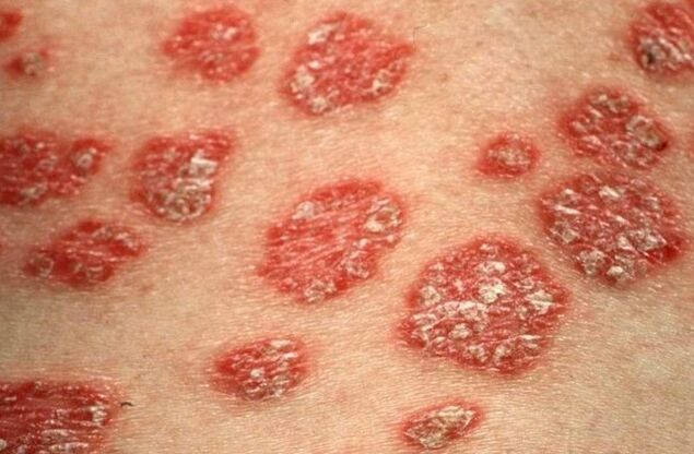 Pápulas psoriásicas