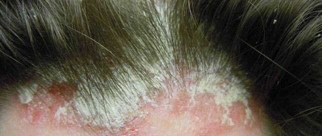 Psoriasis en la cabeza