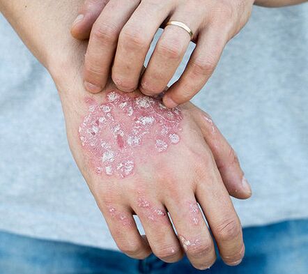 Psoriasis en el brazo