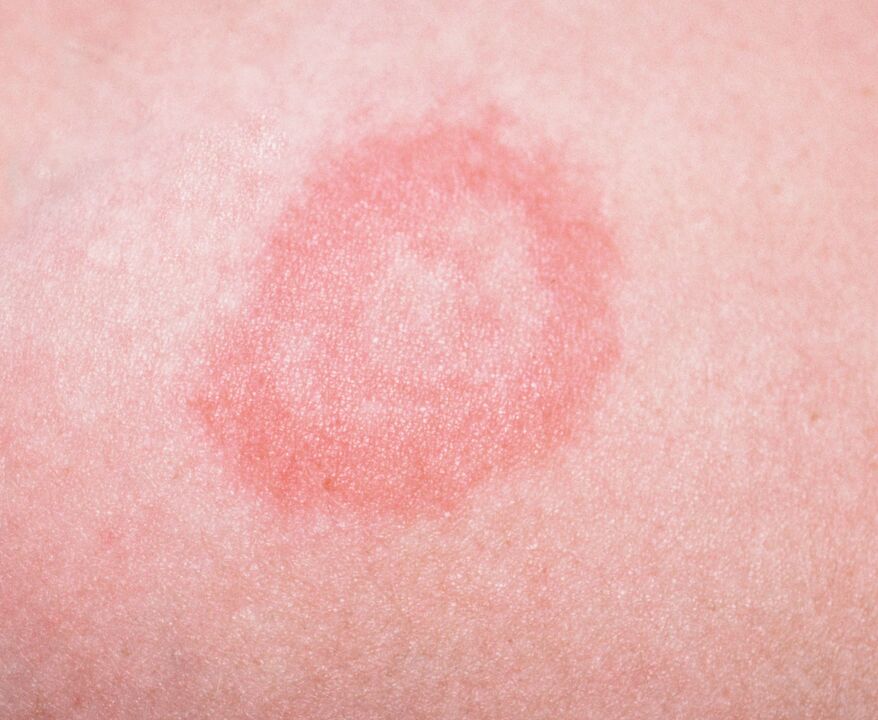 La psoriasis es