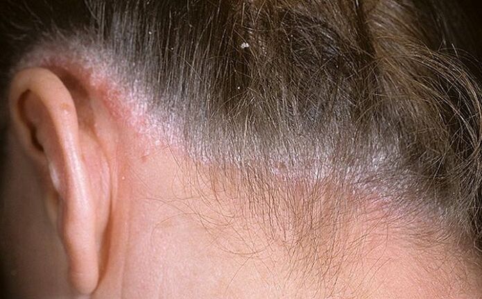 Psoriasis en el cabello