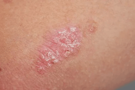 Psoriasis - Etapa inicial