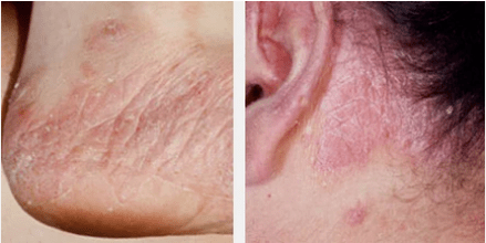 Tipos de psoriasis
