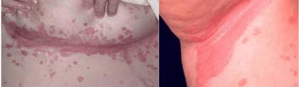 Forma atípica de psoriasis