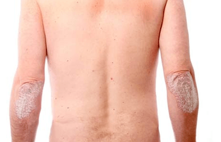 Síntomas generales de la psoriasis