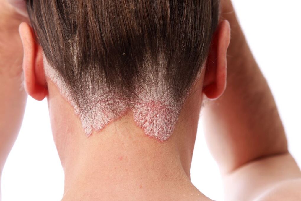 tratamiento de la psoriasis