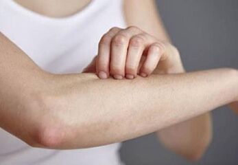 Psoriasis en la mano