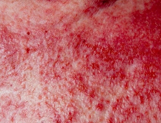 Forma avanzada de psoriasis