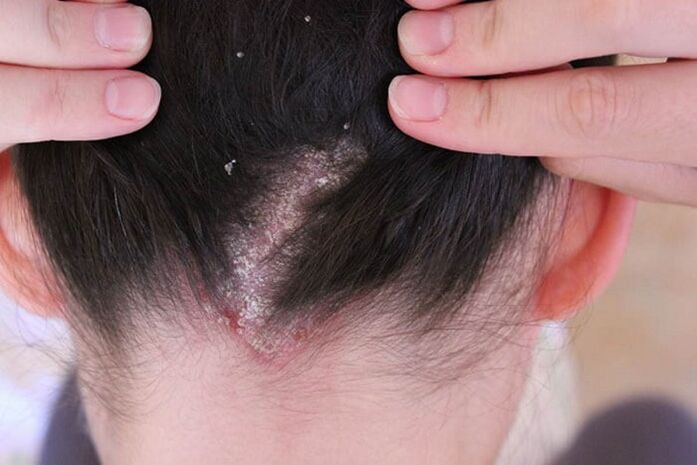 Psoriasis en la cabeza