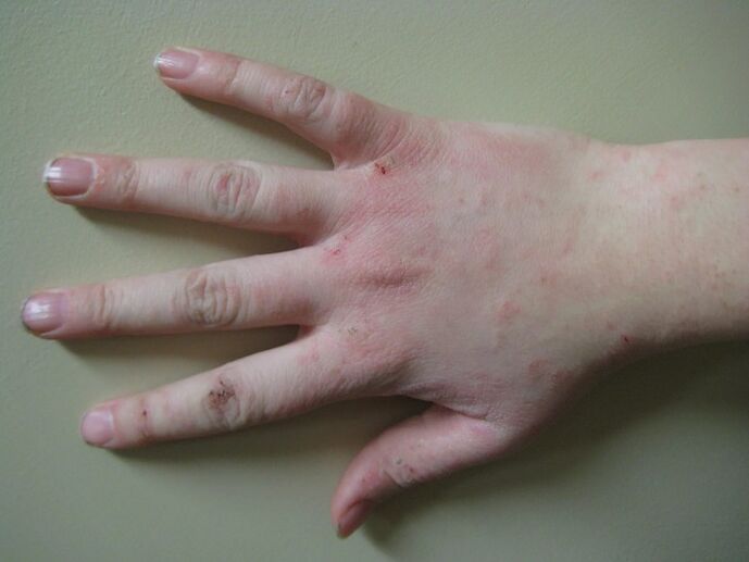 Psoriasis en una etapa temprana