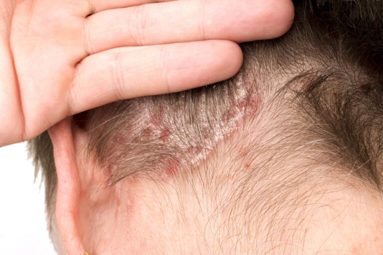 Exacerbación de la psoriasis en la cabeza.