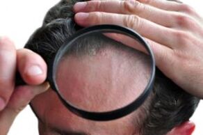 Psoriasis en la cabeza a través de una lupa.