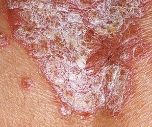 Etapa estacionaria de la psoriasis.
