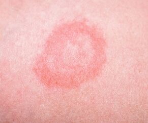 Etapa inicial de la psoriasis.