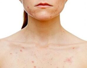 ¿En qué partes del cuerpo aparece la psoriasis