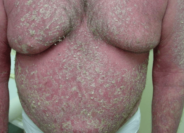 Eritrodermia psoriásica en el cuerpo.