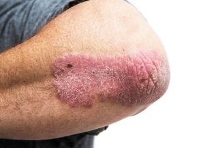 Psoriasis en placas en el codo.