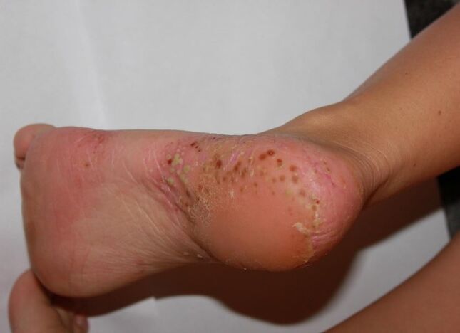 Psoriasis palmoplantar