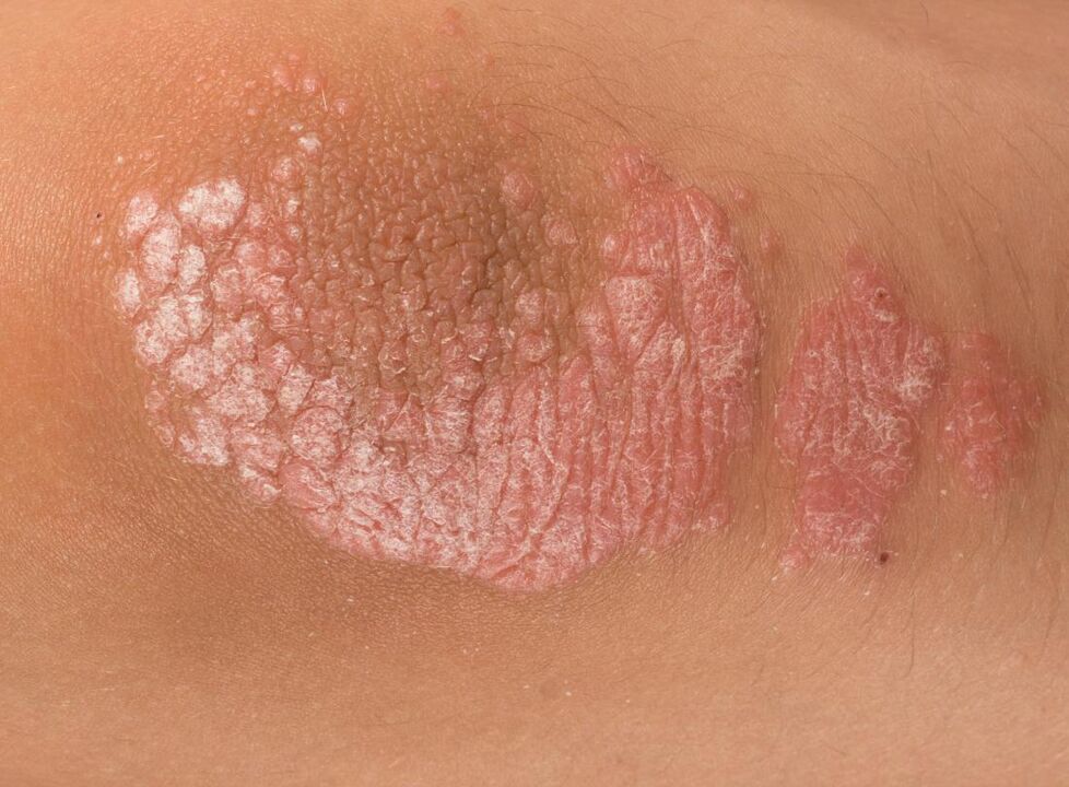 Soriasis