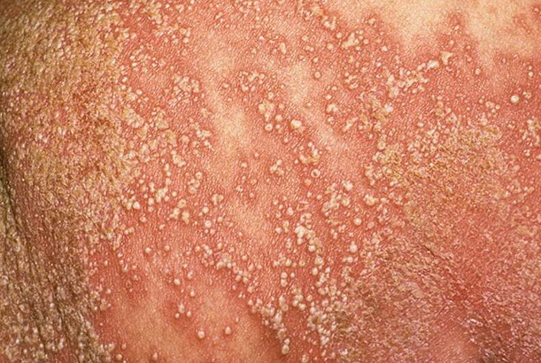 psoriasis pustulosa