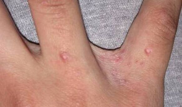 El comienzo de la psoriasis