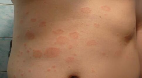 Psoriasis en el cuerpo
