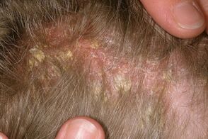 Psoriasis en la cabeza