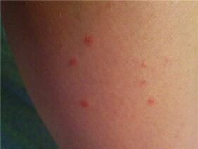 Psoriasis en la piel